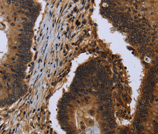 Immunohistochemistry of paraffin-embedded Human colon cancer tissue using FHL3 Polyclonal Antibody at dilution 1:40