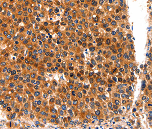 Immunohistochemistry of paraffin-embedded Human liver cancer tissue using FGFR1 Polyclonal Antibody at dilution 1:60