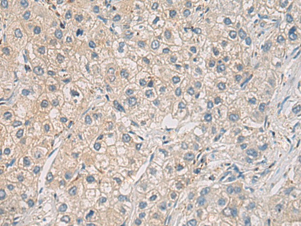 Immunohistochemistry of paraffin-embedded Human liver cancer tissue  using WFDC3 Polyclonal Antibody at dilution of 1:40(?200)