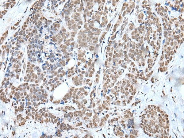 Immunohistochemistry of paraffin-embedded Human thyroid cancer tissue  using WTAP Polyclonal Antibody at dilution of 1:35(?200)