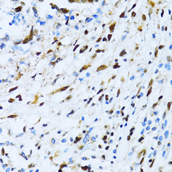 Immunohistochemistry of paraffin-embedded Human gastric cancer using XRCC4 Polyclonal Antibody at dilution of 1:100 (40x lens).