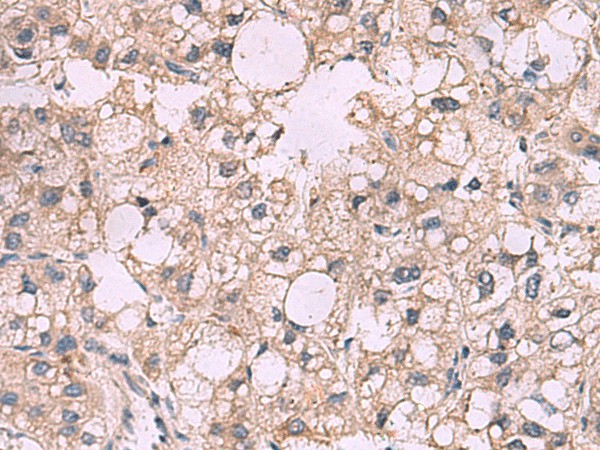 Immunohistochemistry of paraffin-embedded Human liver cancer tissue  using KCNIP1 Polyclonal Antibody at dilution of 1:40(?200)