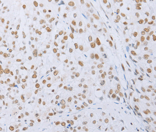 Immunohistochemistry of paraffin-embedded Human esophagus cancer tissue using MCM2 Polyclonal Antibody at dilution 1:50