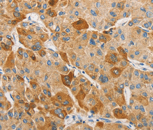 Immunohistochemistry of paraffin-embedded Human liver cancer tissue using APOBEC3G Polyclonal Antibody at dilution 1:50