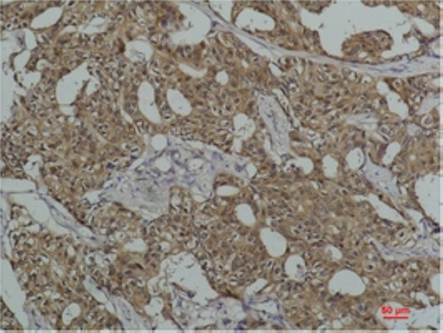 Immunohistochemistry of paraffin-embedded Human breast carcinoma tissue using HSPA8 Monoclonal Antibody at dilution of 1:200.