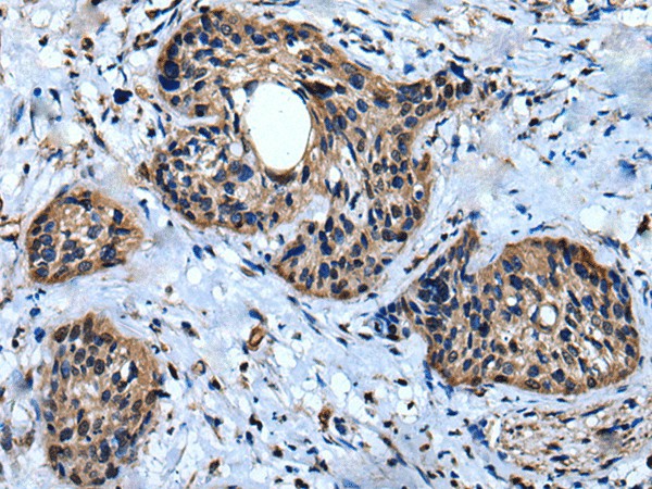 Immunohistochemistry of paraffin-embedded Human cervical cancer tissue  using IQGAP1 Polyclonal Antibody at dilution of 1:30(?200)