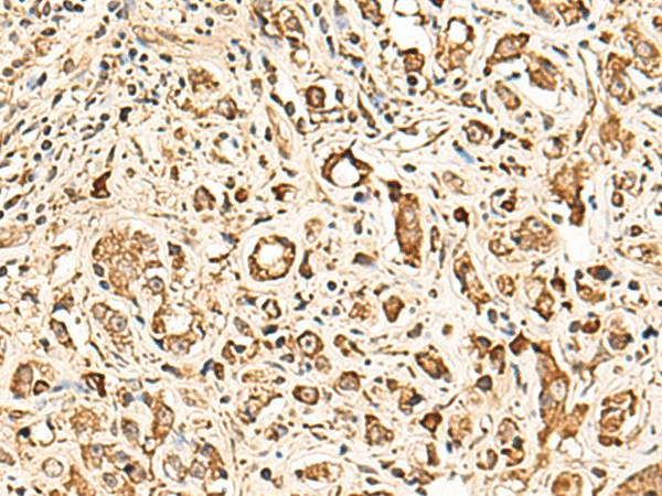 Immunohistochemistry of paraffin-embedded Human prost ate cancer tissue  using SOX3 Polyclonal Antibody at dilution of 1:50(?200)