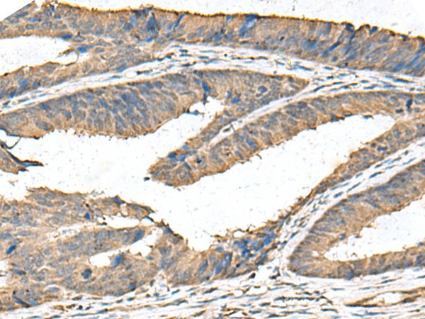 Immunohistochemistry of paraffin-embedded Human colorectal cancer tissue  using FAM19A4 Polyclonal Antibody at dilution of 1:65(?200)