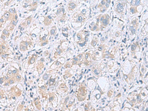 Immunohistochemistry of paraffin-embedded Human liver cancer tissue  using GPCPD1 Polyclonal Antibody at dilution of 1:55(?200)