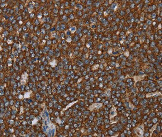 Immunohistochemistry of paraffin-embedded Human ovarian cancer tissue using GCKR Polyclonal Antibody at dilution 1:40