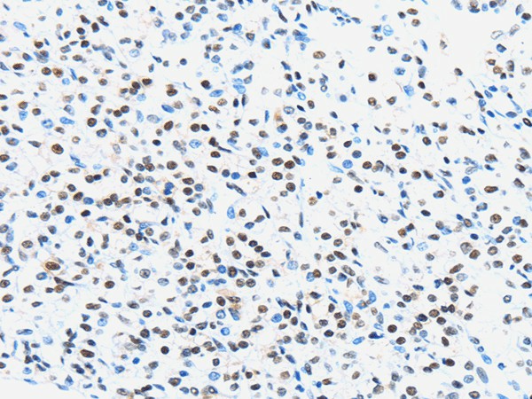 Immunohistochemistry of paraffin-embedded Human prostate cancer using UBA1 Polyclonal Antibody at dilution of  1/40