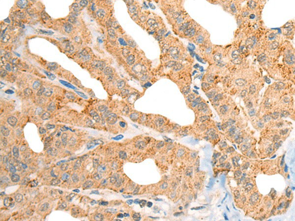 Immunohistochemistry of paraffin-embedded Human thyroid cancer tissue  using CECR1 Polyclonal Antibody at dilution of 1:40(?200)