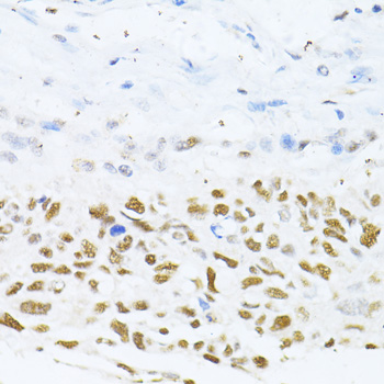 Immunohistochemistry of paraffin-embedded human lung cancer using DNMT1 Polyclonal Antibody at dilution of 1:100 (40x lens).Perform microwave antigen retrieval with 10 mM PBS buffer pH 7.2 before commencing with IHC staining protocol.