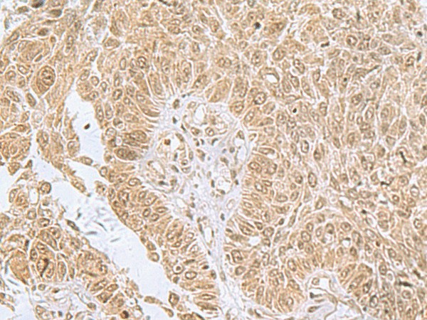 Immunohistochemistry of paraffin-embedded Human lung cancer tissue  using PHF6 Polyclonal Antibody at dilution of 1:85(?200)