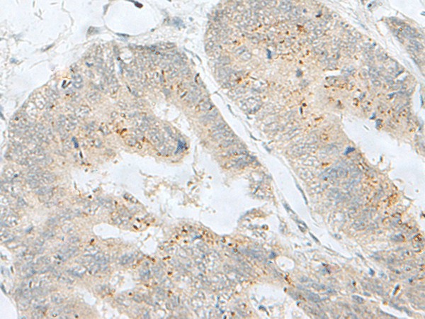 Immunohistochemistry of paraffin-embedded Human colorectal cancer tissue  using MLNR Polyclonal Antibody at dilution of 1:35(?200)