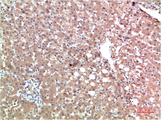 Immunohistochemistry of paraffin-embedded Human liver carcinoma tissue using TTR Monoclonal Antibody at dilution of 1:200.