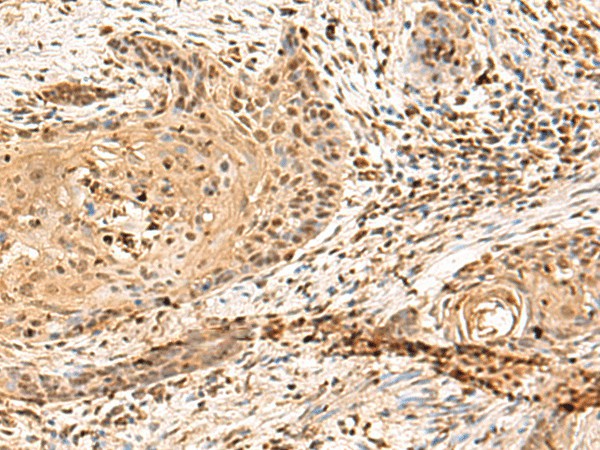 Immunohistochemistry of paraffin-embedded Human esophagus cancer tissue  using PTH1R Polyclonal Antibody at dilution of 1:65(?200)