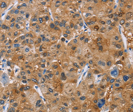 Immunohistochemistry of paraffin-embedded Human liver cancer tissue using NCR3 Polyclonal Antibody at dilution 1:40