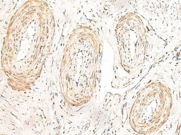 Immunohistochemistry of paraffin-embedded Human cervical cancer tissue  using GPR160 Polyclonal Antibody at dilution of 1:35(?200)