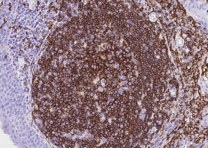 CD20/MS4A1 Monoclonal Antibody - small - 2