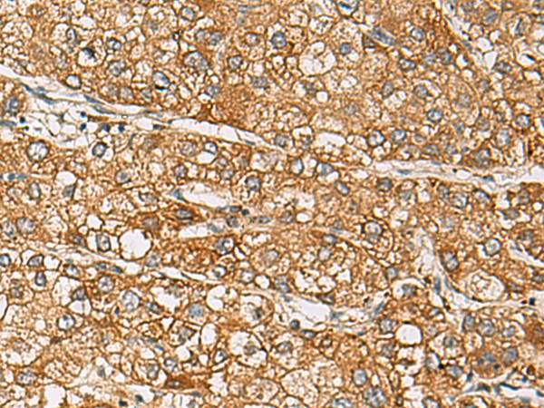 Immunohistochemistry of paraffin-embedded Human liver cancer tissue  using DCAF12 Polyclonal Antibody at dilution of 1:65(?200)