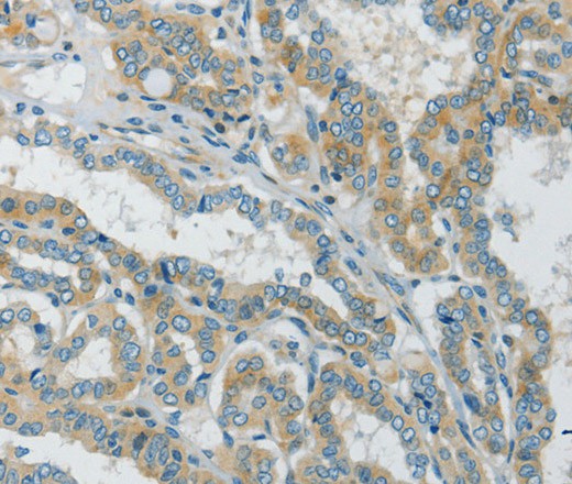 Immunohistochemistry of paraffin-embedded Human thyroid cancer tissue using Connexin-45 Polyclonal Antibody at dilution 1:50