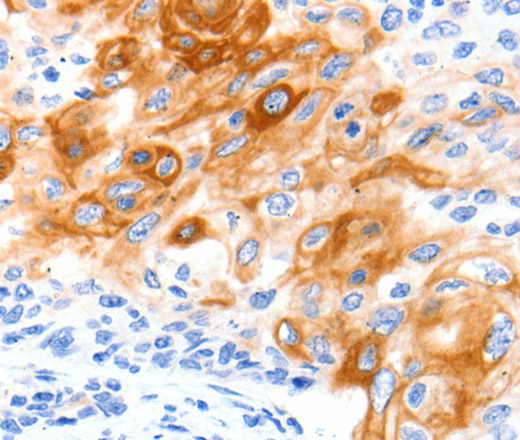 Immunohistochemistry of paraffin-embedded Human cervical cancer tissue using SLC2A11 Polyclonal Antibody at dilution 1:140