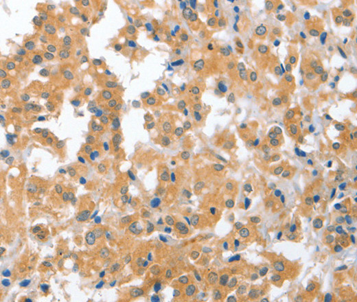 Immunohistochemistry of paraffin-embedded Human thyroid cancer tissue using CDR2 Polyclonal Antibody at dilution 1:60