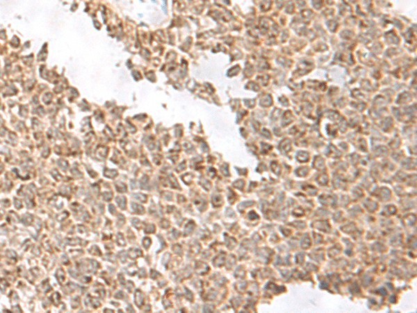 Immunohistochemistry of paraffin-embedded Human ovarian cancer tissue  using USP16 Polyclonal Antibody at dilution of 1:75(?200)