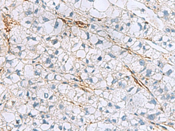 Immunohistochemistry of paraffin-embedded Human liver cancer tissue  using TAGLN3 Polyclonal Antibody at dilution of 1:60(?200)