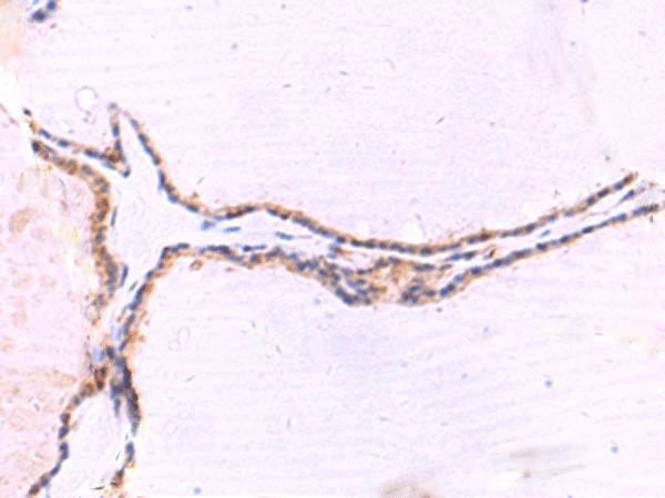 Immunohistochemistry of paraffin-embedded Human thyroid cancer tissue  using IRGC Polyclonal Antibody at dilution of 1:30(?200)