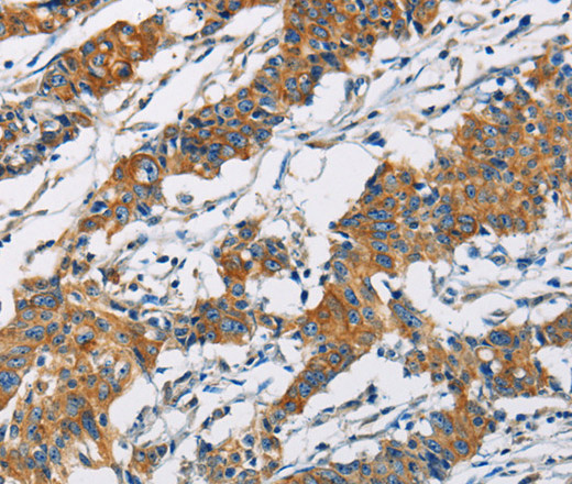 Immunohistochemistry of paraffin-embedded Human gastic cancer using PIP4K2A Polyclonal Antibody at dilution of 1:40