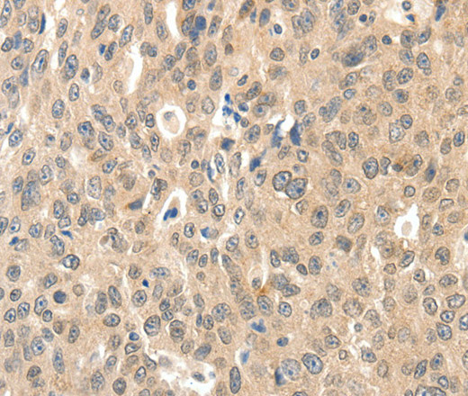 Immunohistochemistry of paraffin-embedded Human ovarian cancer tissue using ROS1 Polyclonal Antibody at dilution 1:40