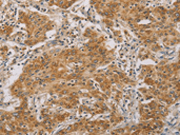 Immunohistochemistry of paraffin-embedded Human gasrtic cancer tissue  using CDKN2A Polyclonal Antibody at dilution of 1:50(?200)