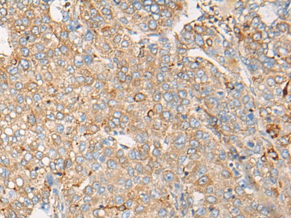 Immunohistochemistry of paraffin-embedded Human liver cancer tissue  using CAPN9 Polyclonal Antibody at dilution of 1:45(?200)