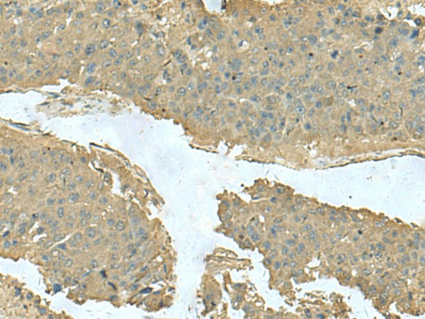 Immunohistochemistry of paraffin-embedded Human liver cancer tissue  using KRT36 Polyclonal Antibody at dilution of 1:50(?200)