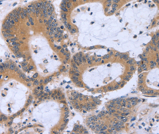 Immunohistochemistry of paraffin-embedded Human colon cancer using ECE1 Polyclonal Antibody at dilution of 1:30