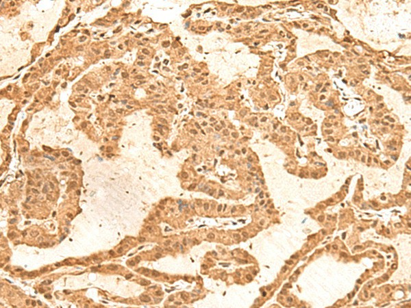 Immunohistochemistry of paraffin-embedded Human thyroid cancer tissue  using TIPRL Polyclonal Antibody at dilution of 1:60(?200)