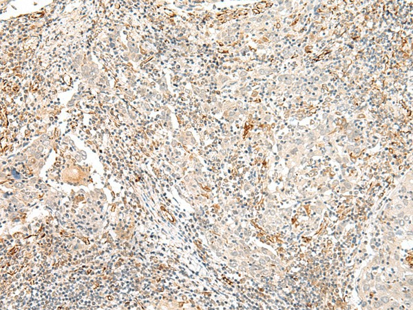 Immunohistochemistry of paraffin-embedded Human cervical cancer tissue  using TAAR2 Polyclonal Antibody at dilution of 1:40(?200)