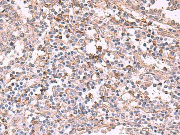 Immunohistochemistry of paraffin-embedded Human tonsil tissue  using ADH1B Polyclonal Antibody at dilution of 1:55(?200)