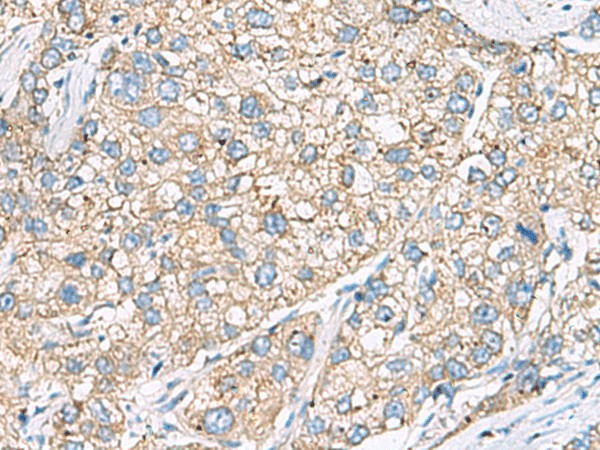 Immunohistochemistry of paraffin-embedded Human liver cancer tissue  using SHC3 Polyclonal Antibody at dilution of 1:40(?200)