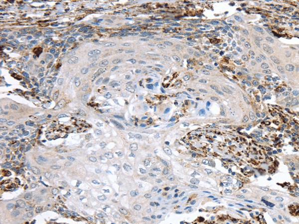 Immunohistochemistry of paraffin-embedded Human cervical cancer using TBXA2R Polyclonal Antibody at dilution of  1/40