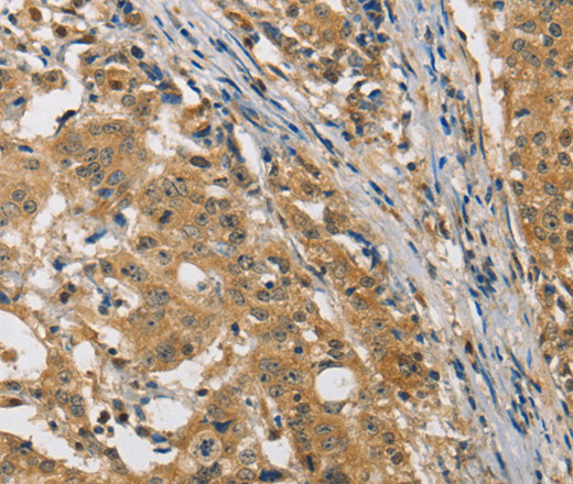 Immunohistochemistry of paraffin-embedded Human gastric cancer tissue using MIP Polyclonal Antibody at dilution 1:50