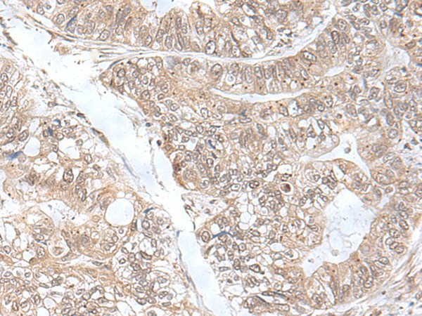 Immunohistochemistry of paraffin-embedded Human gastric cancer tissue  using SNRNP25 Polyclonal Antibody at dilution of 1:55(?200)