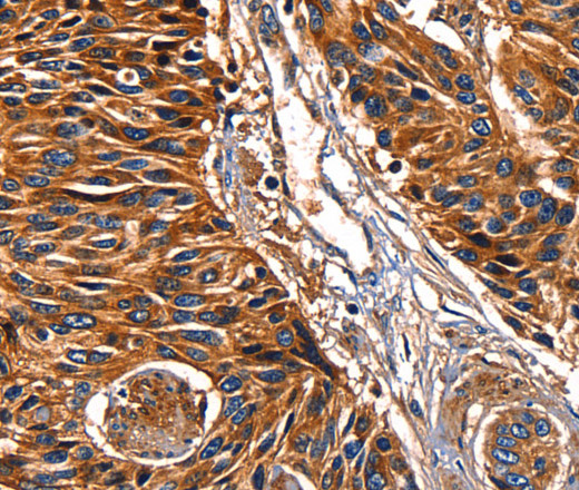 Immunohistochemistry of paraffin-embedded Human esophagus cancer tissue using Galectin 8 Polyclonal Antibody at dilution 1:50