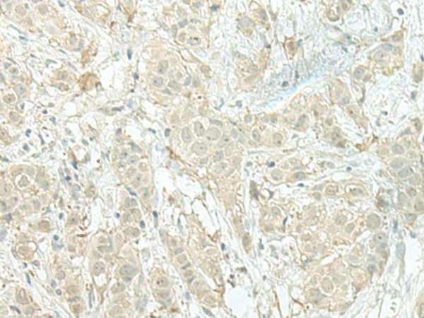 Immunohistochemistry of paraffin-embedded Human breast cancer tissue  using MIEN1 Polyclonal Antibody at dilution of 1:100(?200)