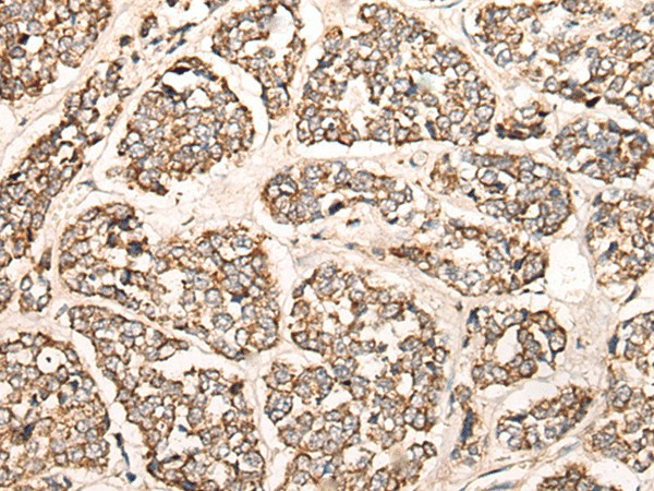 Immunohistochemistry of paraffin-embedded Human esophagus cancer tissue  using C1S Polyclonal Antibody at dilution of 1:55(?200)