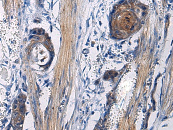 Immunohistochemistry of paraffin-embedded Human esophagus cancer tissue  using ICA1 Polyclonal Antibody at dilution of 1:50(?200)