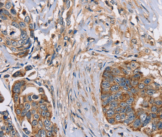 Immunohistochemistry of paraffin-embedded Human cervical cancer using FAIM2 Polyclonal Antibody at dilution of 1:30