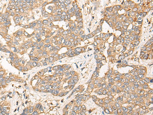 Immunohistochemistry of paraffin-embedded Human liver cancer tissue  using CPNE3 Polyclonal Antibody at dilution of 1:40(?200)